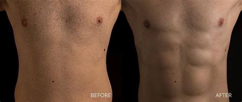 male liposuction miami|Male Liposuction in Miami with Dr. Mendieta 